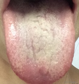 舌苔　湿