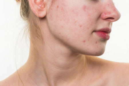 bad-habits-that-can-cause-pimples