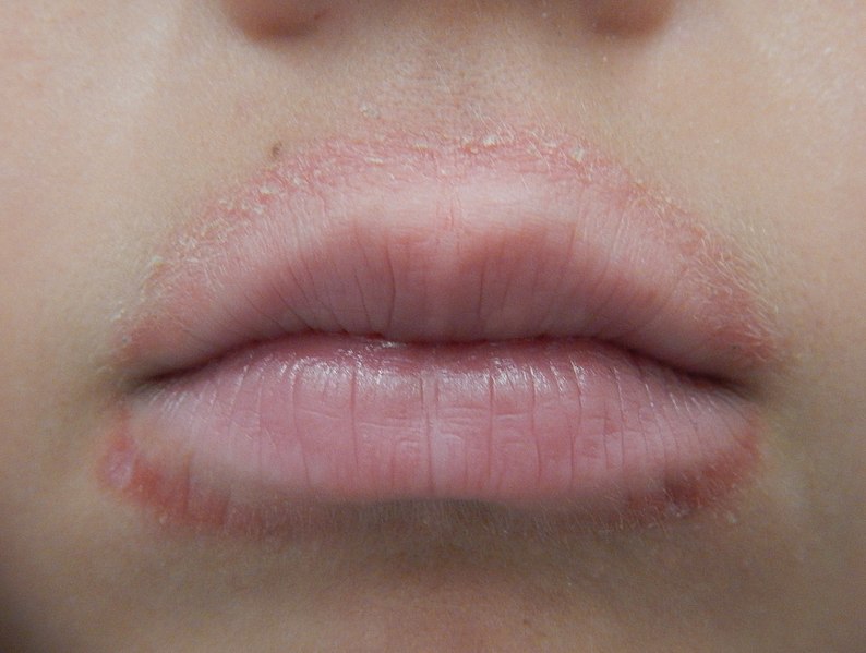 795px lip licker's dermatitis