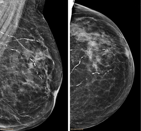 Arteriolosclerosis_mammography
