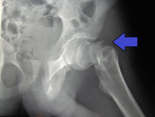 cdm hip fracture 343