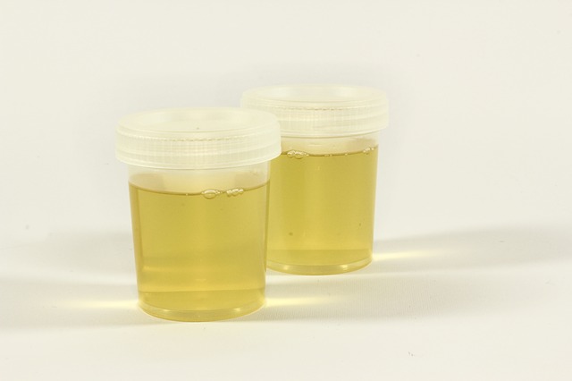 inflammation urine container urine the test