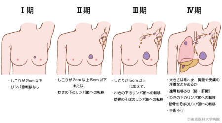 乳がんステージ